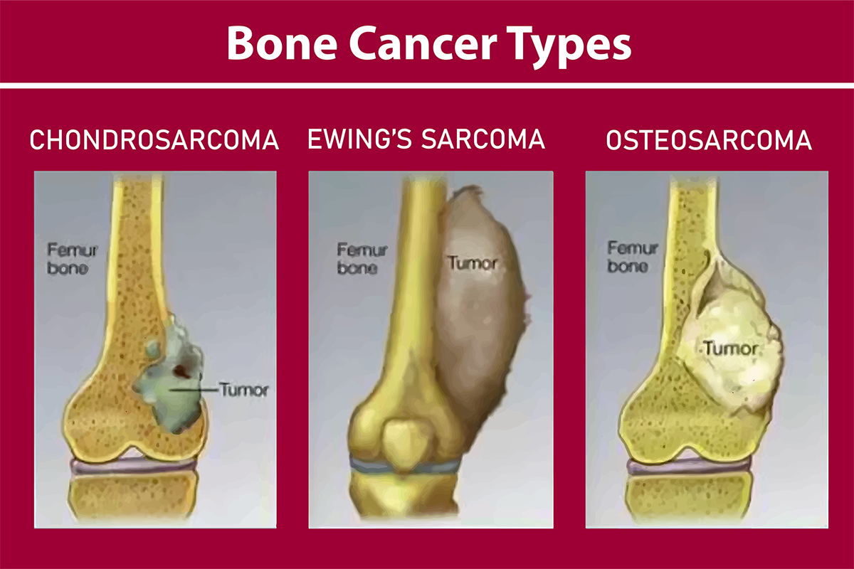 Bone Cancer - Estecharat